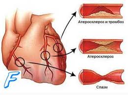 Стенокардия стабильная1